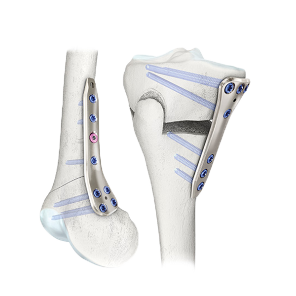 Osteotomy Plates 4.5