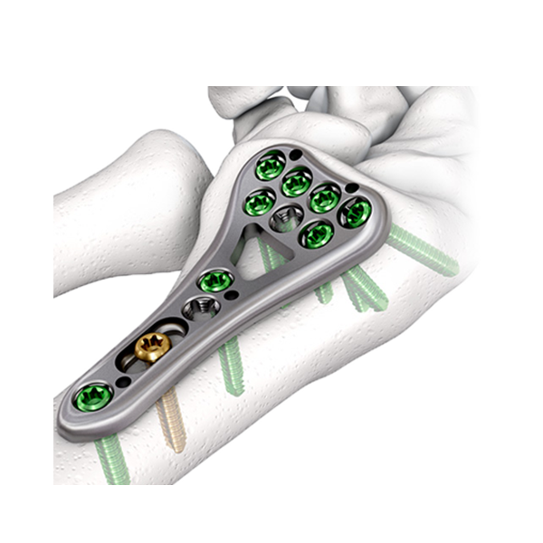 Distal Radius/Ulna Plates 2.5